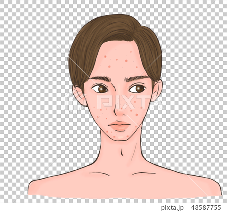 にきびに悩む男性 48587755