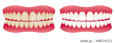 歯 ホワイトニング before after 広告イラスト 歯 ホワイトニング before after 広告イラスト 48624121
