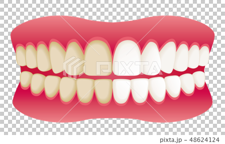 歯 ホワイトニング before after 広告イラスト 歯 ホワイトニング before after 広告イラスト 48624124