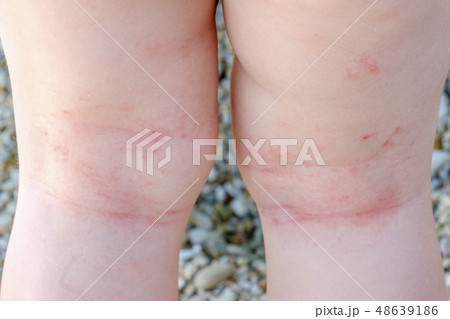 skin irritation newborn closeup atopic dermatitis 48639186
