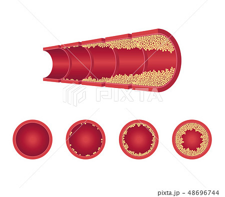 Vector atherosclerosis vein artery throms flat set 48696744