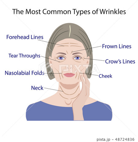 Common Types of Facial Wrinkles. cosmetic surgery. Common Types of Facial Wrinkles. cosmetic surgery. 48724836