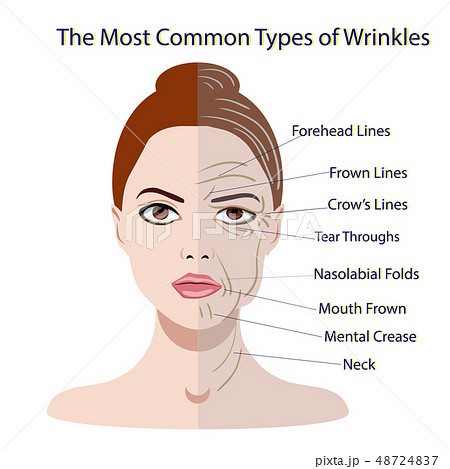 Common Types of Facial Wrinkles. cosmetic surgery. Common Types of Facial Wrinkles. cosmetic surgery. 48724837