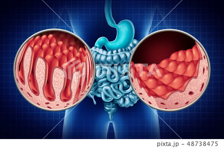 Celiac Intestine Disease 48738475