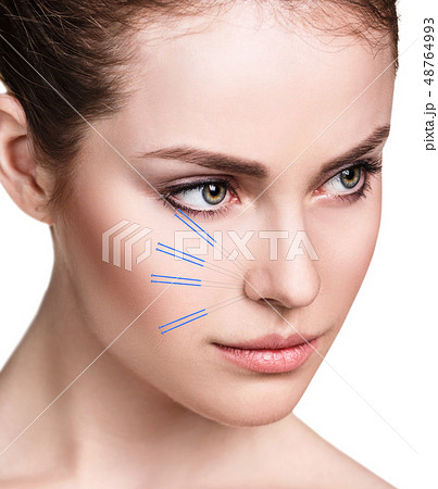 Woman undergoing acupuncture treatment. Woman undergoing acupuncture treatment. 48764993