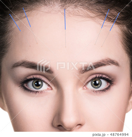 Woman undergoing acupuncture treatment. 48764994