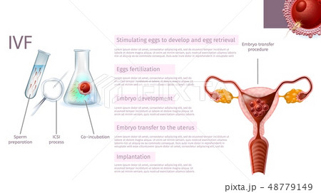 In Vitro Fertilization Stages. Medical Banner. 48779149