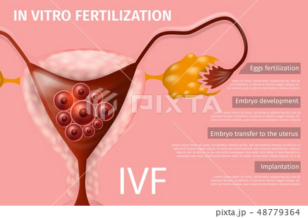 Womans Eggs In Vitro Fertilization, Implantation 48779364