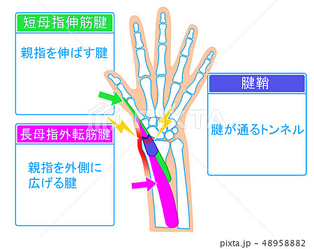 腱鞘炎　解説図 48958882