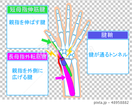 腱鞘炎　解説図 48958882