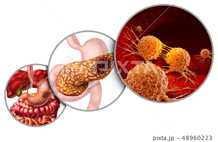 Pancreas Cancer Anatomy Pancreas Cancer Anatomy 48960223