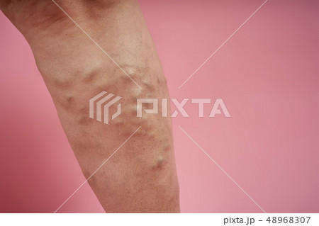 legs of senior woman with varicose veins on coral background. 48968307