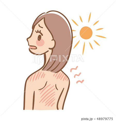 日焼け 女性 直射日光 背中 肩 日焼け 女性 直射日光 背中 肩 48979775