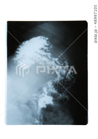 X ray image of stomach X ray image of stomach 48997105
