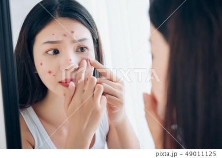 Asian woman squeeze acne problem face  49011125