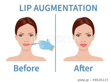 Lip augmentation with hyaluronic acid. 49026115