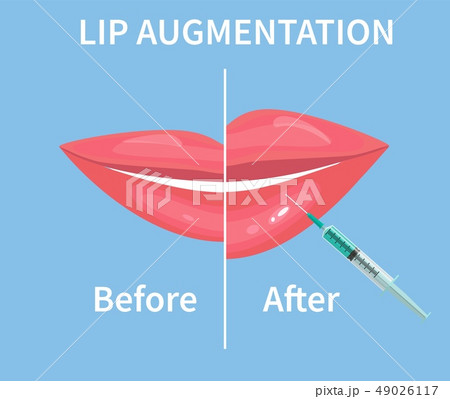 Lip Augmentation. Before and after lip filler injections. illustration 49026117