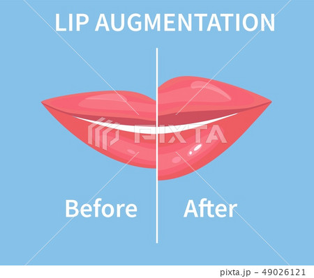 Lip Augmentation. Before and after lip filler injections. illustration 49026121