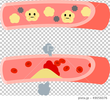 血管内の中性脂肪とアテロームのイラスト素材