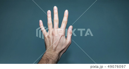 Left Hand With Broken Finger And Ganglion Cyst Left Hand With Broken Finger And Ganglion Cyst 49076097
