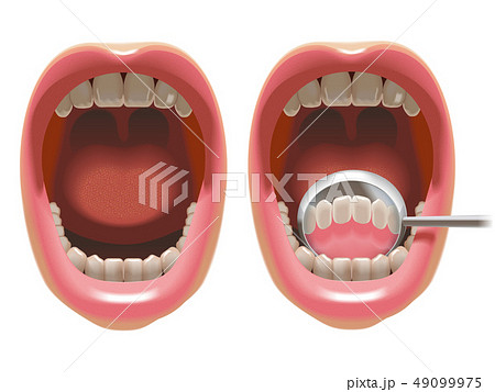 デンタルミラーで前歯の裏を見るのイラスト素材