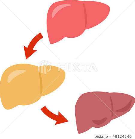 正常な肝臓 脂肪肝 肝硬変のイラスト素材