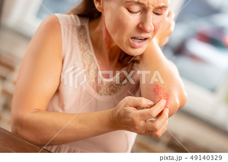 Mature woman feeling pain having reddening on neck and elbows Mature woman feeling pain having reddening on neck and elbows 49140329
