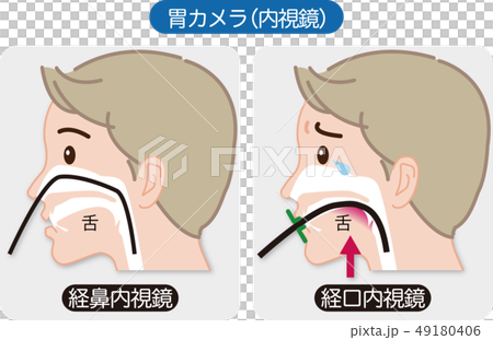 胃カメラ検査（経鼻内視鏡と経口内視鏡）の説明図（表情入り） 49180406