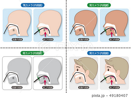 胃カメラ検査 経鼻内視鏡と経口内視鏡 の説明図 ４タイプのイラスト素材