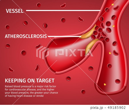 Atherosclerotic Vessels Medical Disease Banner 49185902