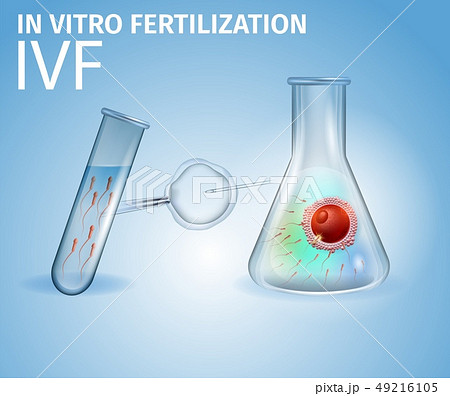 Methods of Infertility Treatment, IVF, Egg, Sperm Methods of Infertility Treatment, IVF, Egg, Sperm 49216105
