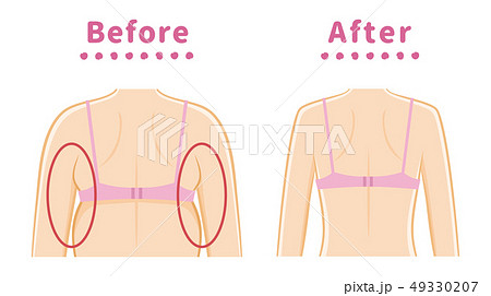 脇のハミ肉 ビフォーアフターのイラスト素材