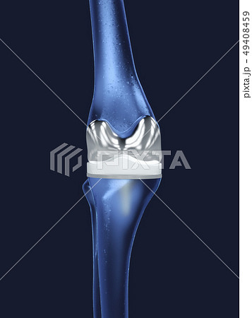 Artificial knee joint or knee implant 49408459