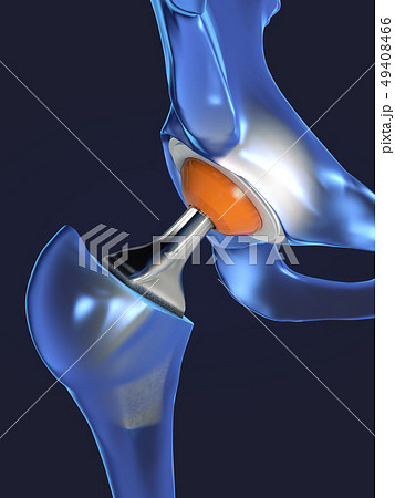 Function of a hip joint implant or hip prosthesis Function of a hip joint implant or hip prosthesis 49408466