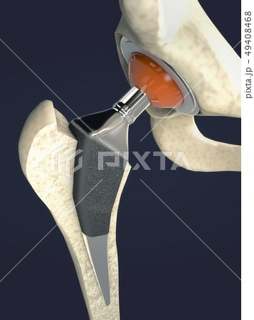 Function of a hip joint implant or hip prosthesis 49408468