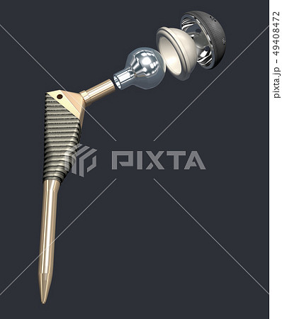 Function of a hip joint implant or hip prosthesis 49408472