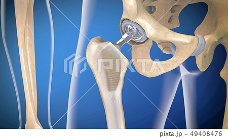 Function of a hip joint implant or hip prosthesis 49408476