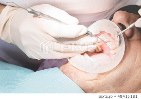 Extreme macro closeup of an open male human mouth showing the preparation for the installation of Extreme macro closeup of an open male human mouth showing the preparation for the installation of 49415181