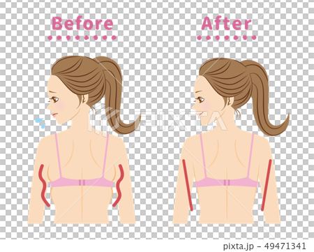 脇のハミ肉 ビフォーアフター 脇のハミ肉 ビフォーアフター 49471341