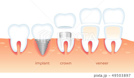 Teeth Problems. Diseased Tooth in Gum. Stomatology 49503897