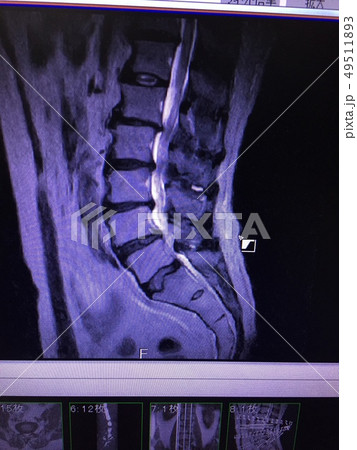腰椎変性すべり症 MRI 脊柱管狭窄症 手術 腰椎変性すべり症 MRI 脊柱管狭窄症 手術 49511893