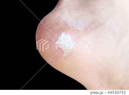 close up pain foot corn isolated on black 49539752
