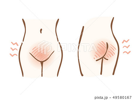 デリケートゾーン 肌トラブル デリケートゾーン 肌トラブル 49580167