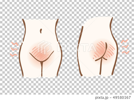 デリケートゾーン 肌トラブル デリケートゾーン 肌トラブル 49580167