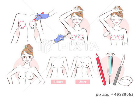 breast plastic surgery concept 49589062