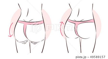 butt implant before and after 49589157