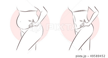 Butt implant before and after Stock Vector by ©estherqueen999