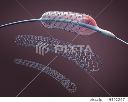 Three metal stents for implantation into artery Three metal stents for implantation into artery 49592267