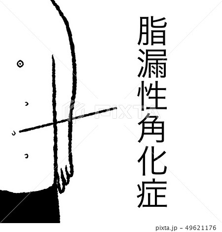 脂漏性角化症 脂漏性角化症 49621176