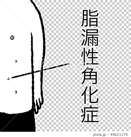脂漏性角化症 脂漏性角化症 49621176